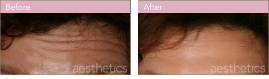 BOTOX Before and After